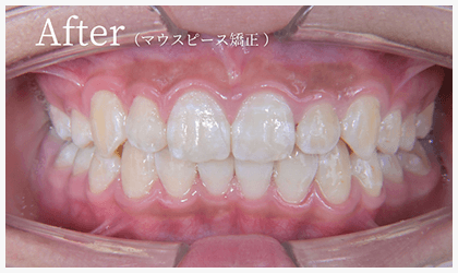 After（マウスピース矯正）