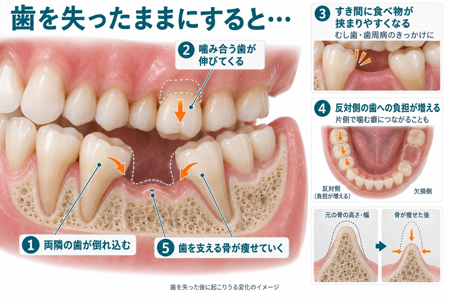 歯を失ったままにした場合に起こりうる5つの変化のイメージ図