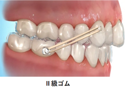 II級ゴム