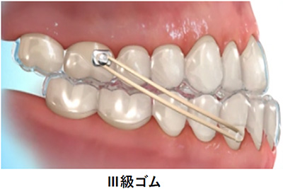 III級ゴム