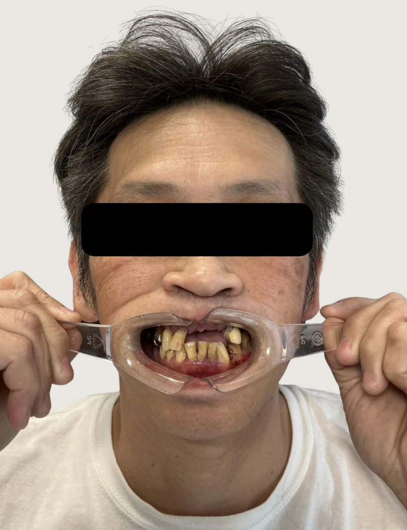 前歯が自然に抜けてしまった。全体的に治したい。ご飯が食べたい。